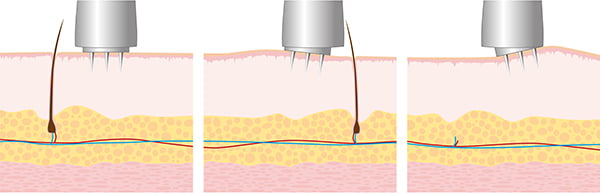 MESO POWER DEVICE 3