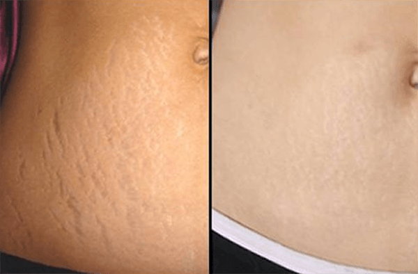 MESO STRETCH MARK REMOVER 4