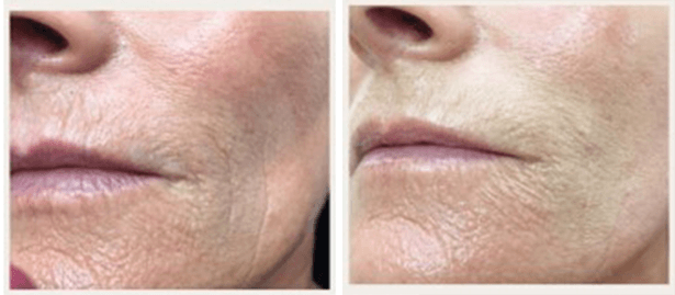 MESO CHEEK LIFT 7