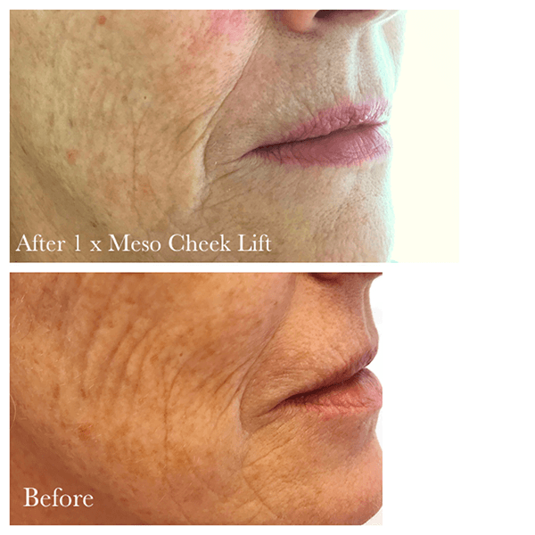 MESO CHEEK LIFT 8