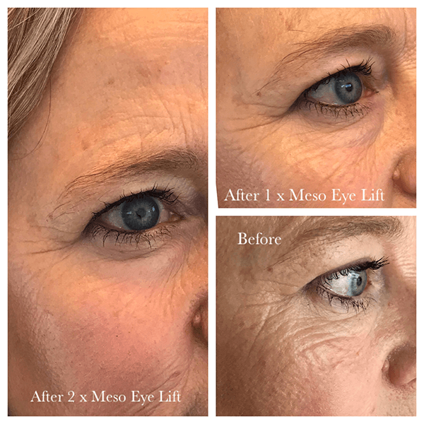 MESO EYE LIFT 6