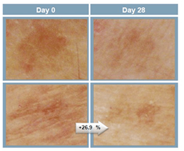 MESO PIGMENT REDUCE 3